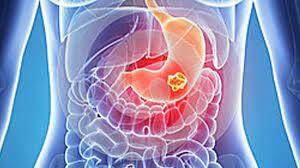 En sık görülen ikinci kanser, sinsice ilerliyor