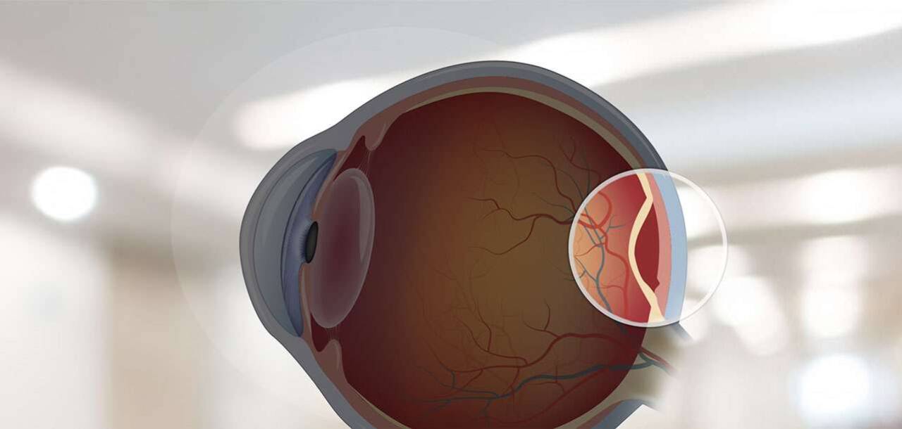 Retina Yırtılması Nasıl Olur?