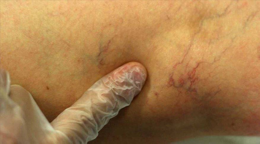 Varis hastalığına 20 dakikada tedavi