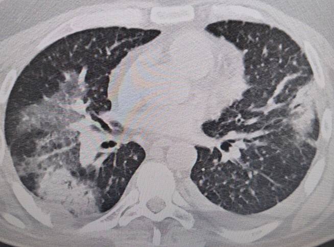 Klimaya bağlı “yaz zatürresine” dikkat