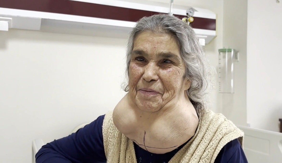 Doktor korkusuyla 50 yıl hastaneye gitmeyen kadın tedavi oldu