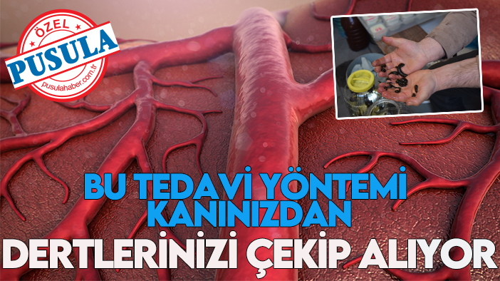 Bu tedavi yöntemi kanınızdan dertlerinizi çekip alıyor