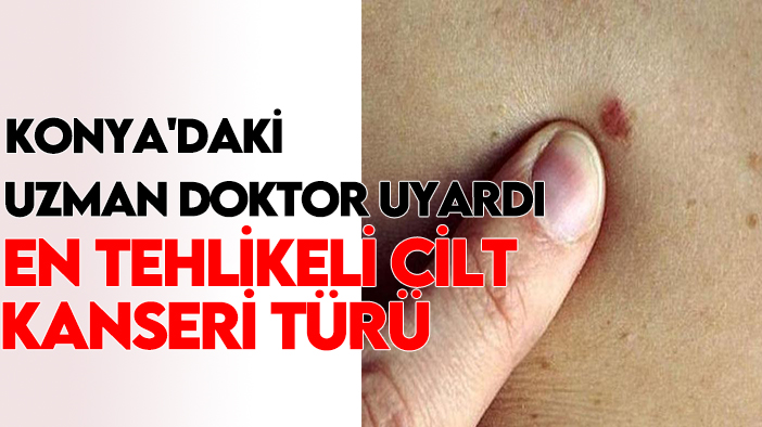 Konya'daki uzman doktor uyardı: En tehlikeli cilt kanseri türü