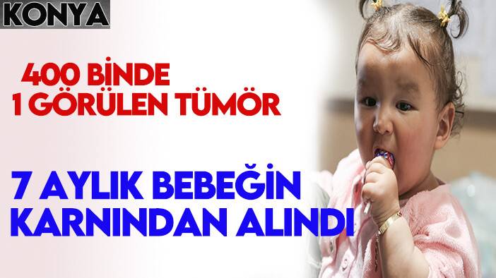 400 binde 1 görülen tümör 7 aylık bebeğin karnından alındı