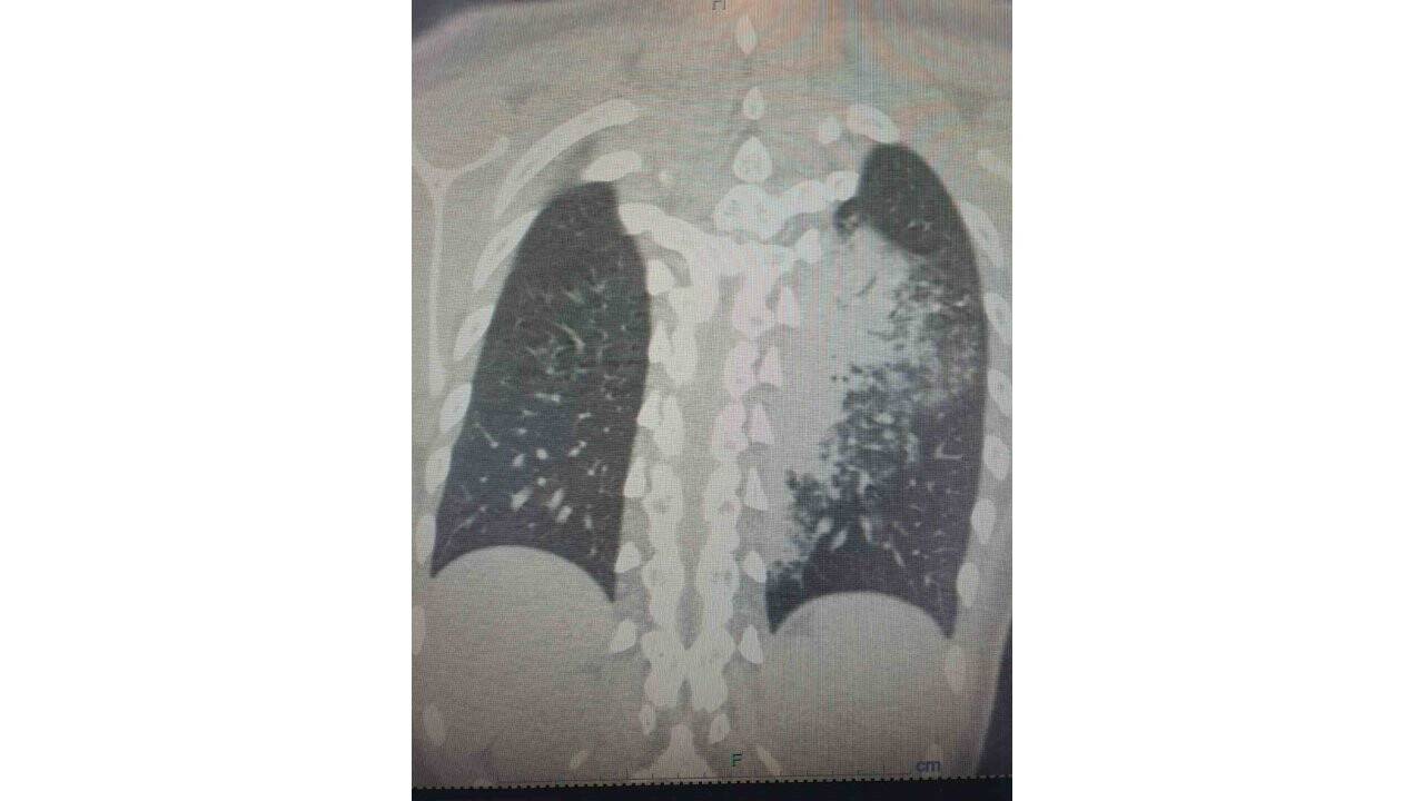 Türkiye’de yeni salgın alarm veriyor: "Lejyoner hastalığı"