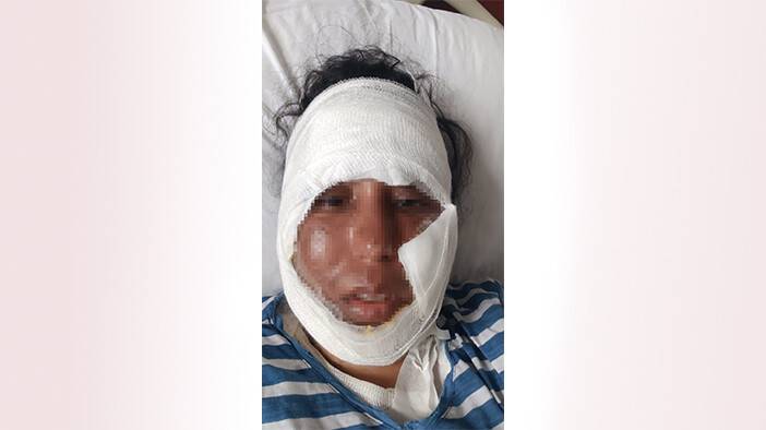 Gelin görümce tartışmasında yüzüne kaynar su döküldü