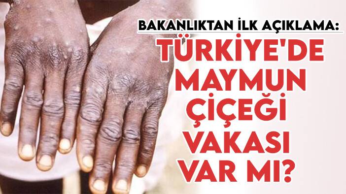 Bakanlıktan ilk açıklama: Türkiye'de maymun çiçeği vakası var mı?