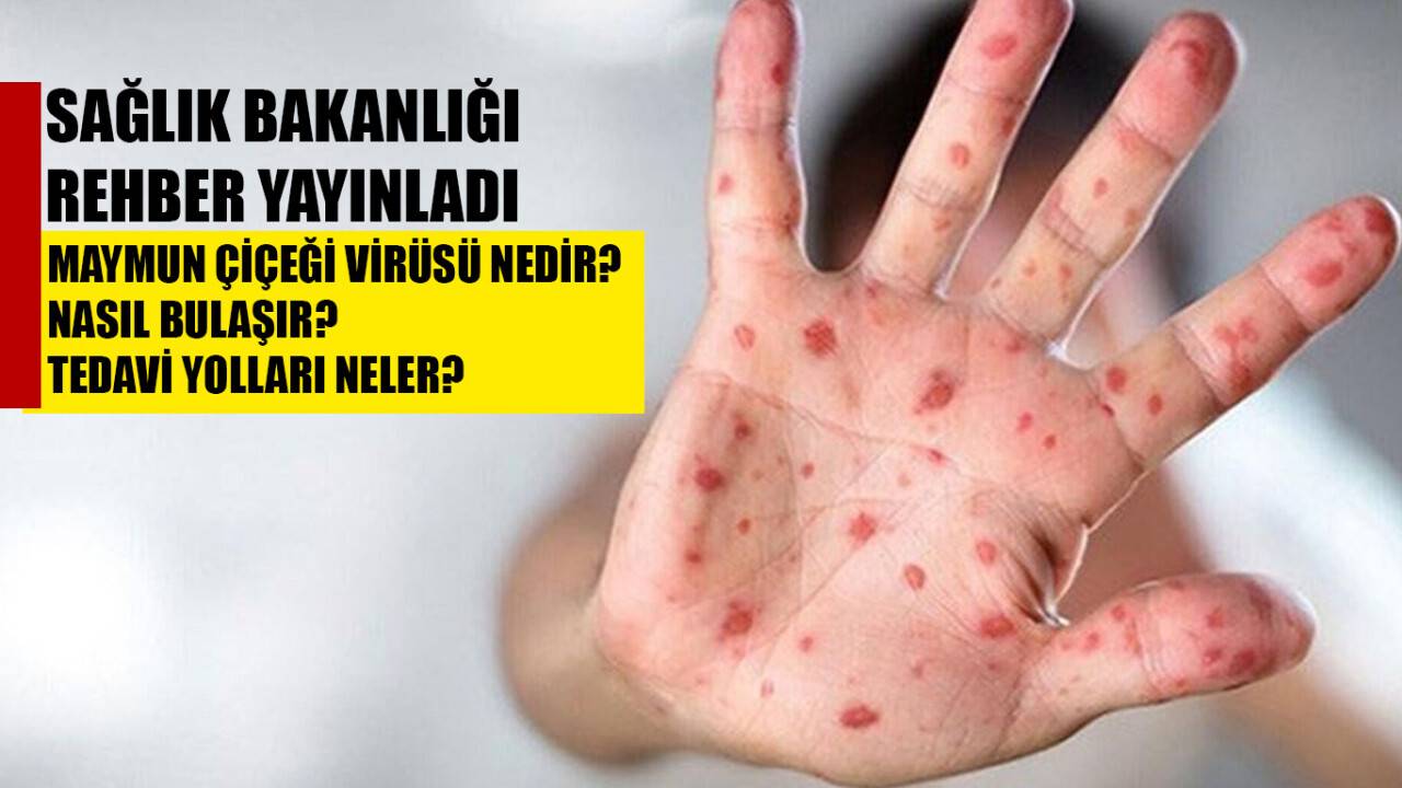 Sağlık Bakanlığı "M çiçeği" rehberini güncelledi