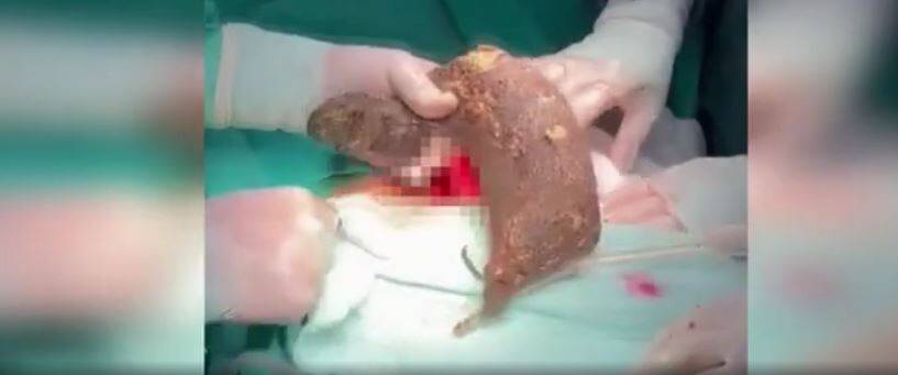 Karın ağrısı diye hastaneye gitti:  Karnından 2 kilogram kıl çıktı