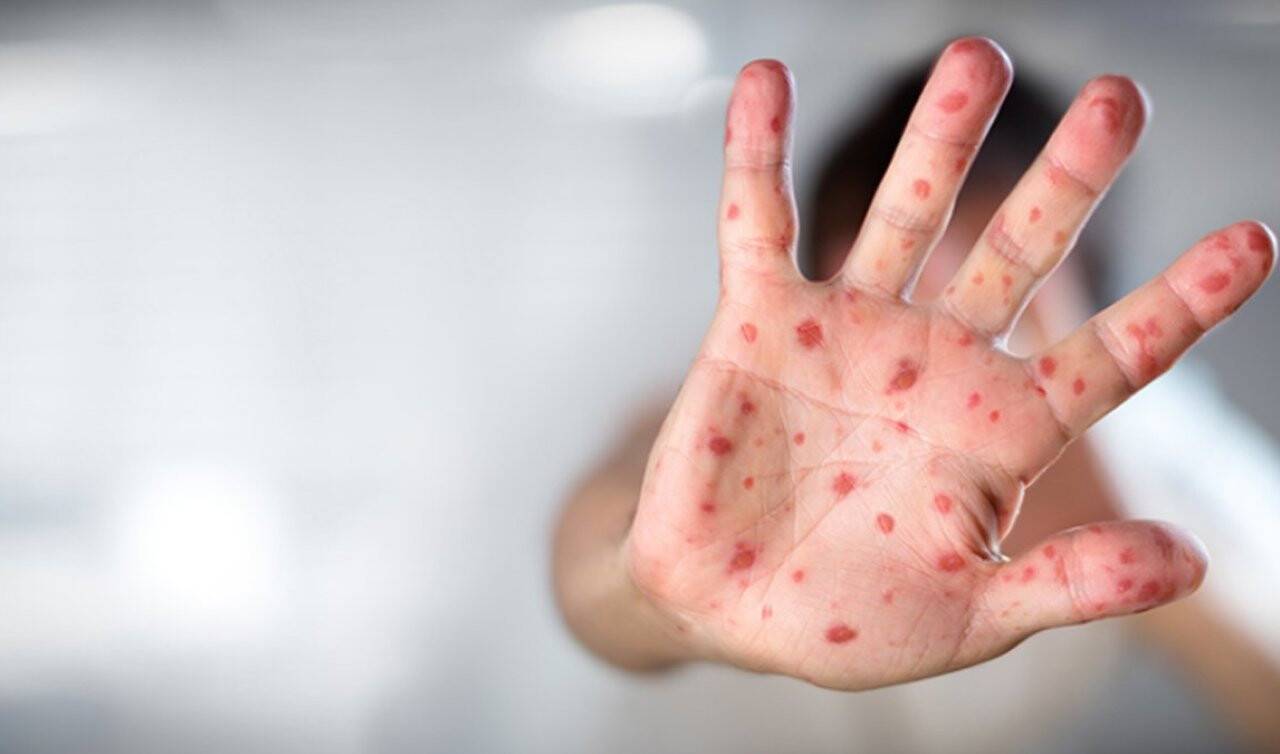 Maymun çiçeği nedir? Belirti ve semptomlar?