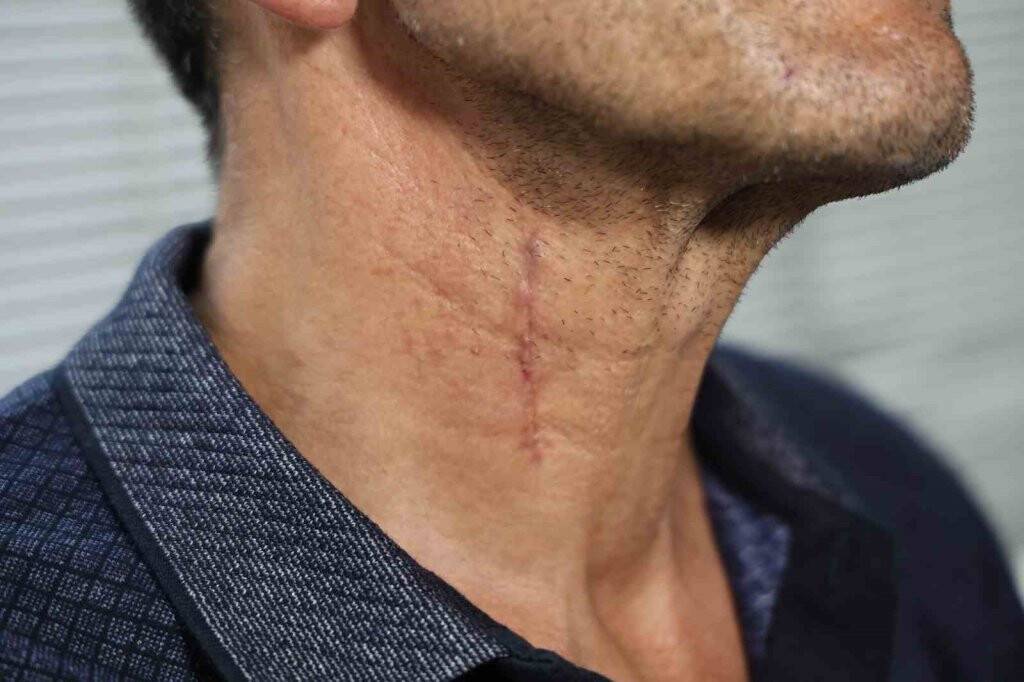 Boyun fıtığı canından ediyordu