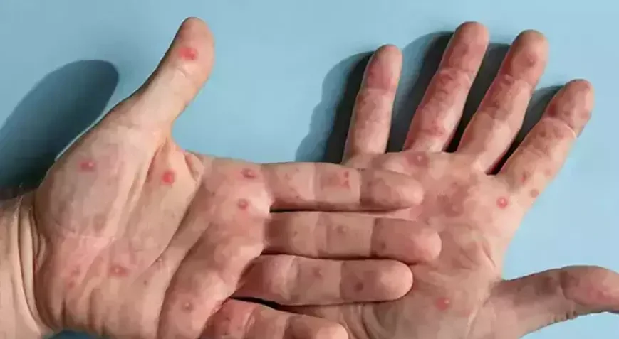 İskenderun Devlet Hastanesinde maymun çiçeği vakası iddiası