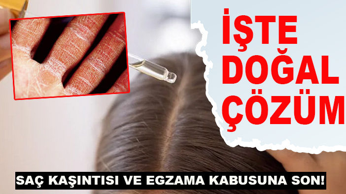 Saç kaşıntısı ve egzama kabusuna son! İşte doğal çözüm