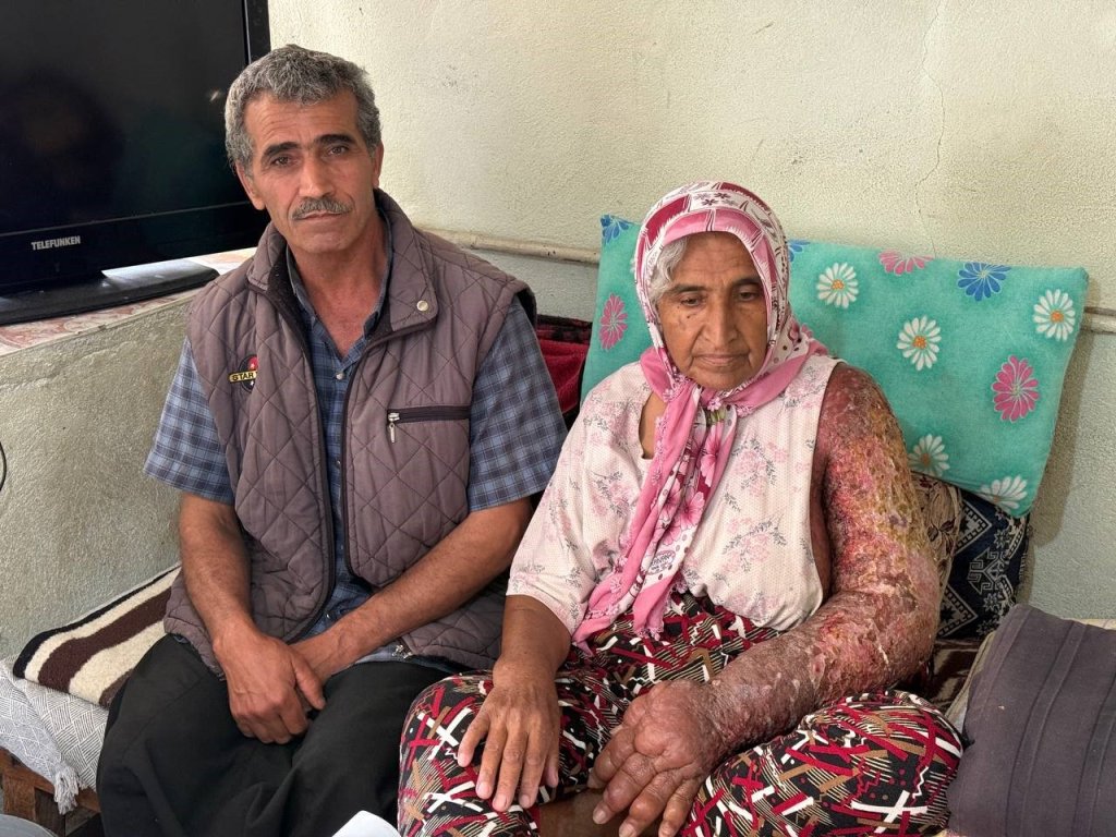 Kolu şişti, vücuduna kadar yara oldu: 4 çocuk annesinin zorlu yaşamı
