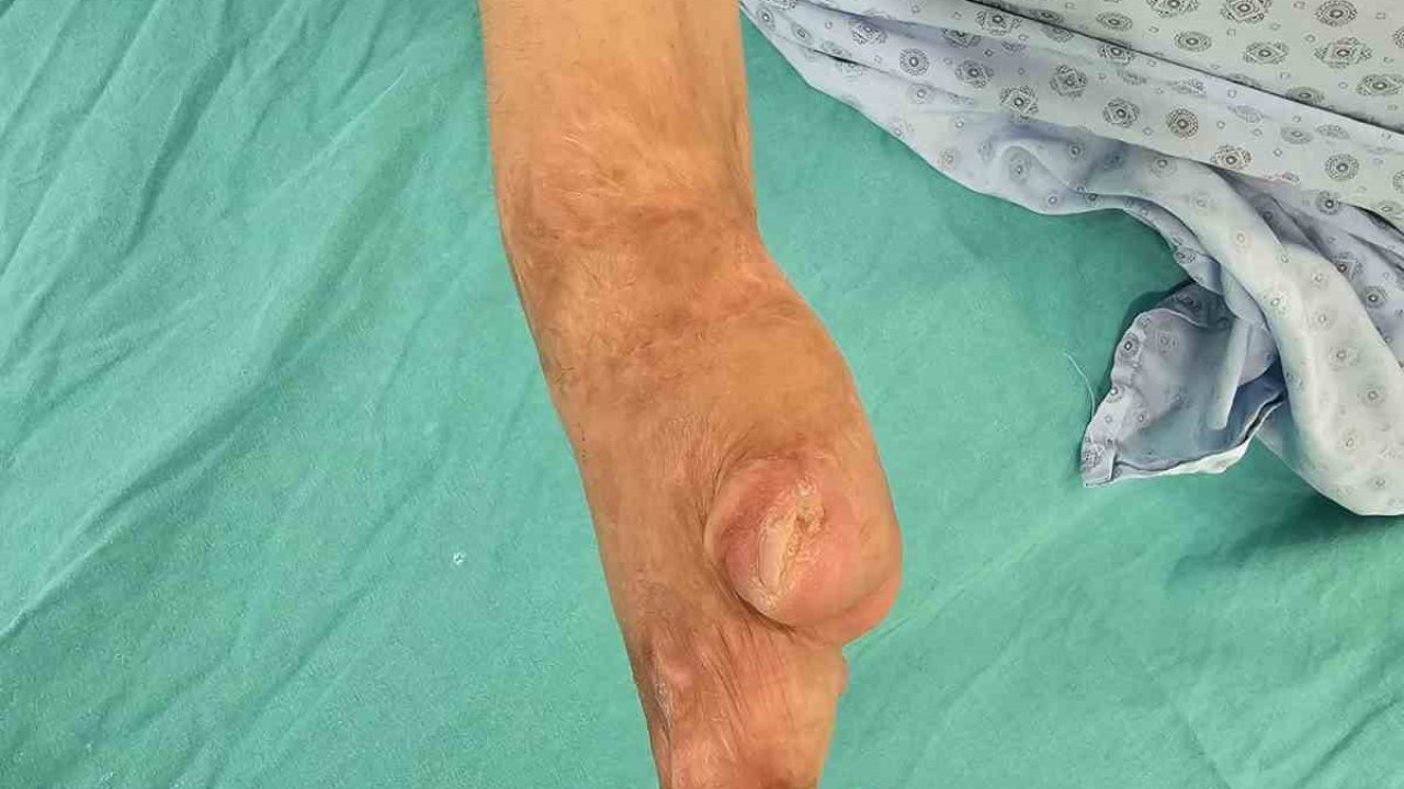 Çin zulmünden kaçan Uygur Türk’ü Ayşe, Eskişehir’de şifa buldu