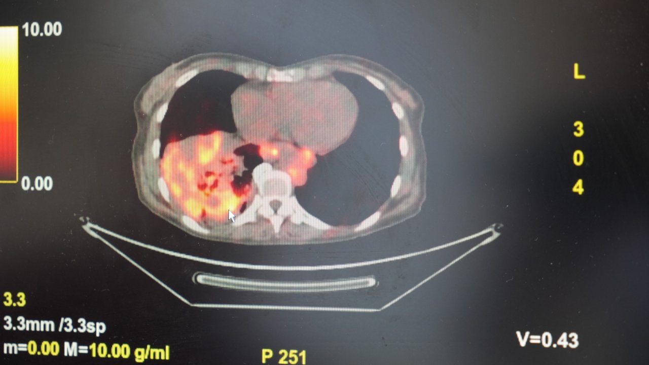 ’Sigarasız akciğer kanseri’ vakalarında dikkat çeken artış