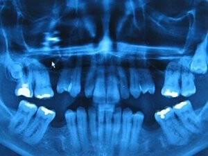 Acısız ve dolgusuz diş tedavi yöntemi geliştirildi