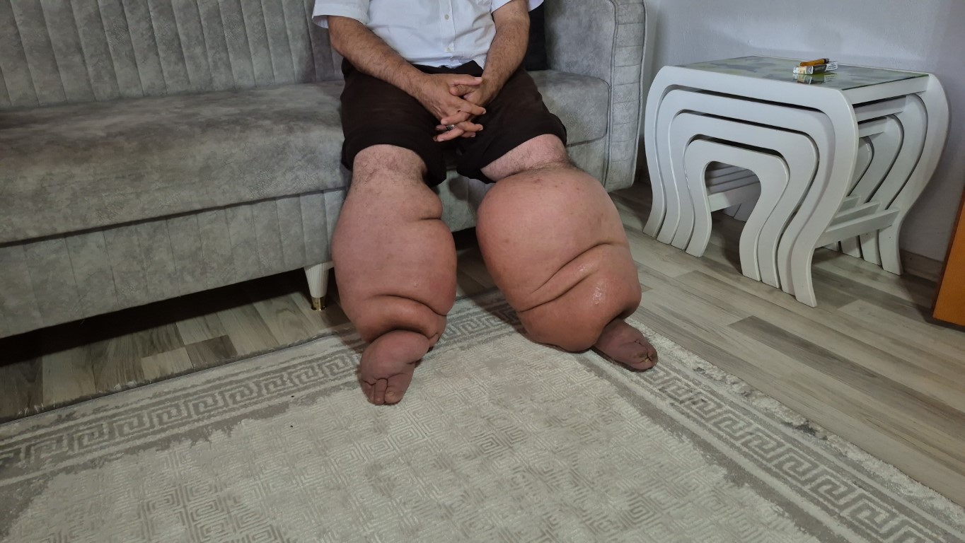 15 yıldır bu hastalıkla mücadele ediyor