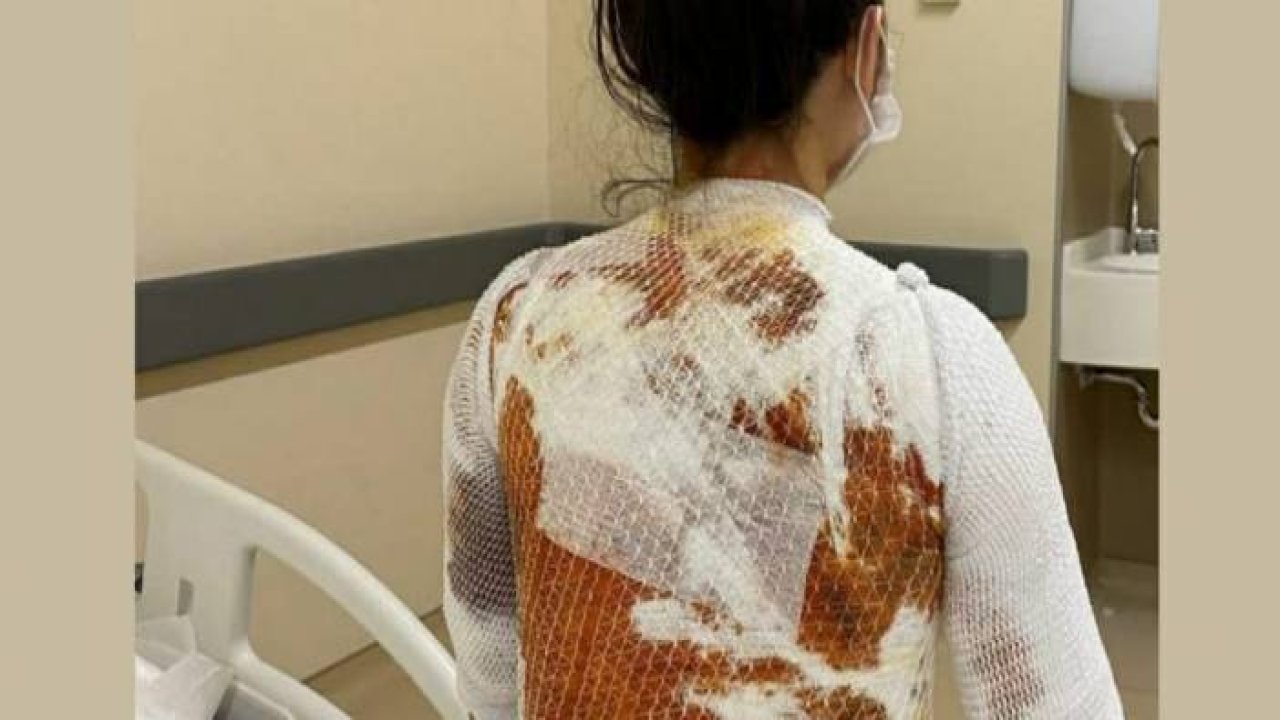 Eşinin kaynar suyla yaktığı Rukiye A: “Ölmek istemiyorum”