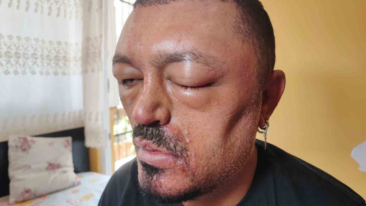 Saçlarını siyahlatmak için aldığı şampuan arı sokmasından beter hale getirdi