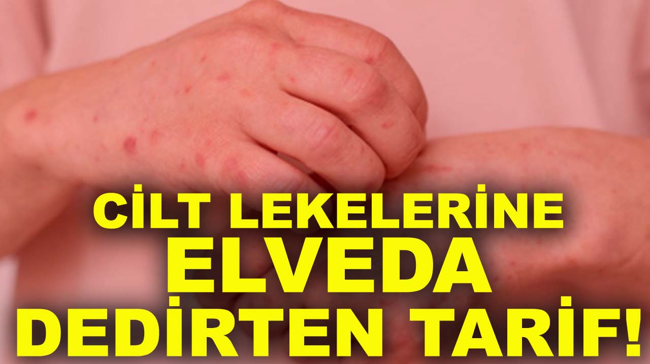 Cilt lekelerine elveda dedirten tarif!