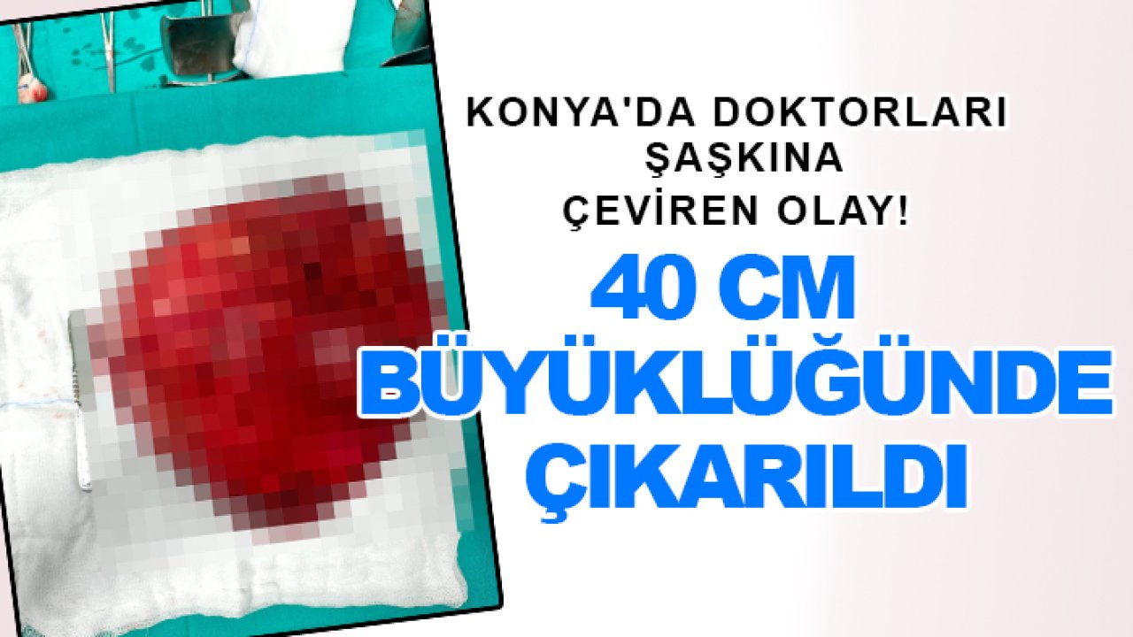 Konya'da doktorları şaşkına çeviren olay! 40 cm büyüklüğünde çıkarıldı
