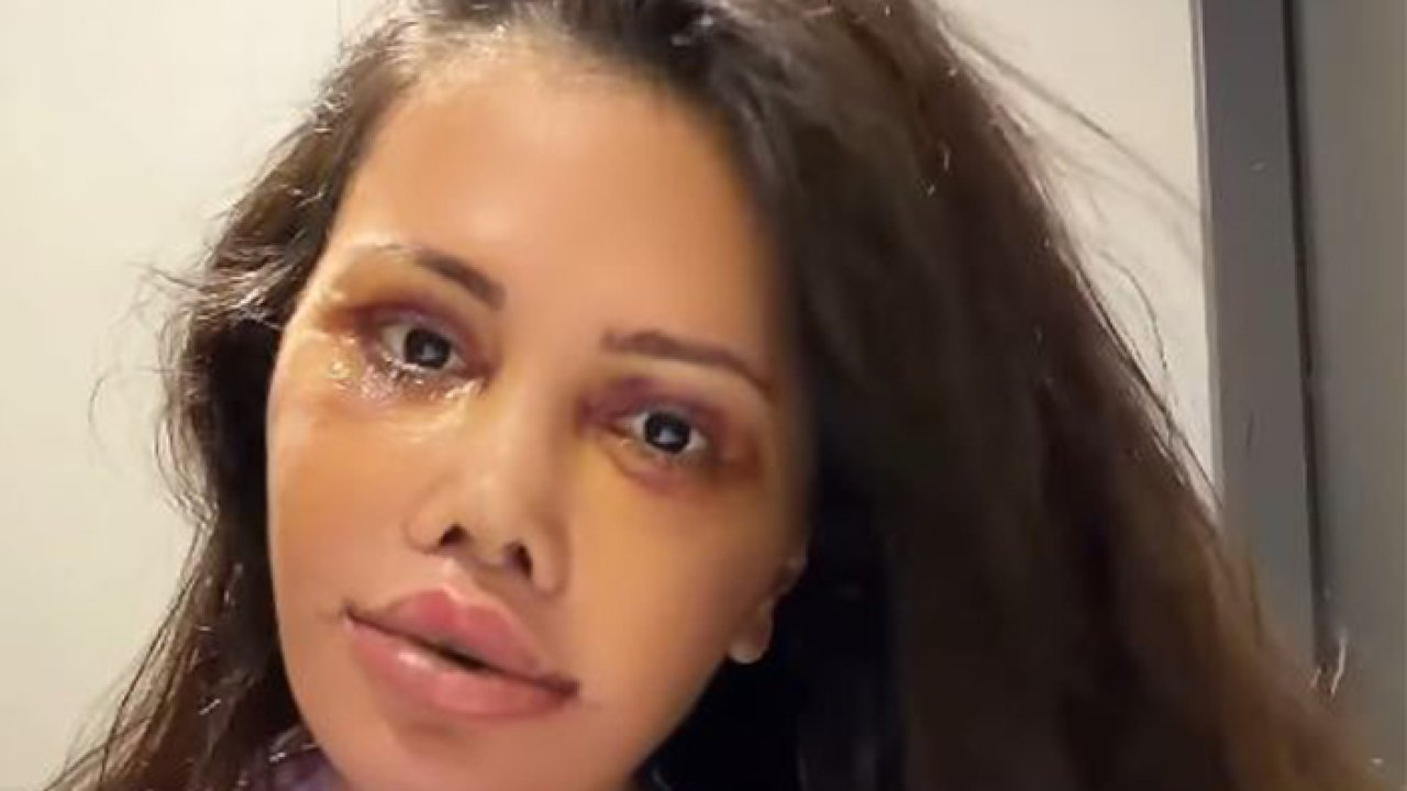 Didem Ceran cilt bakımında çığır açtı! Yüz nakli oldu