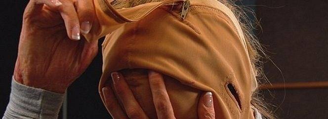 Yanık vücudunu televizyonda gösterdi