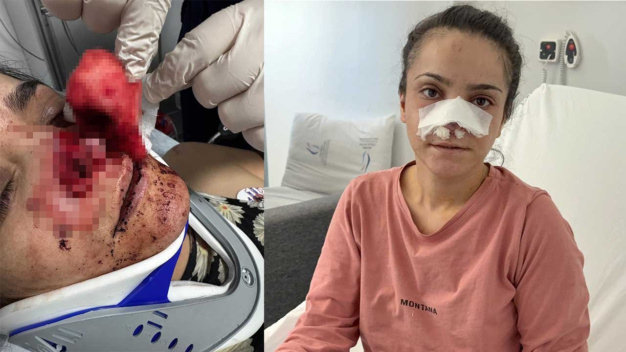 Kavga ettiği eşinin burnunu ısırarak kopardı!