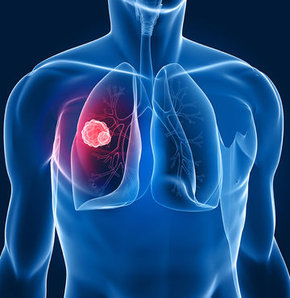 Akciğer kanseri vakaları artıyor