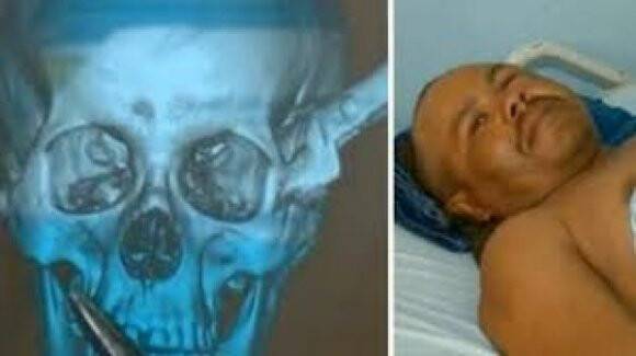 Bıçak gözüne saplanmış durumda araba kullandı!