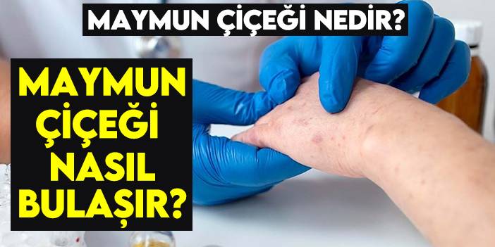 Maymun çiçeği nedir? Maymun çiçeği nasıl bulaşır?
