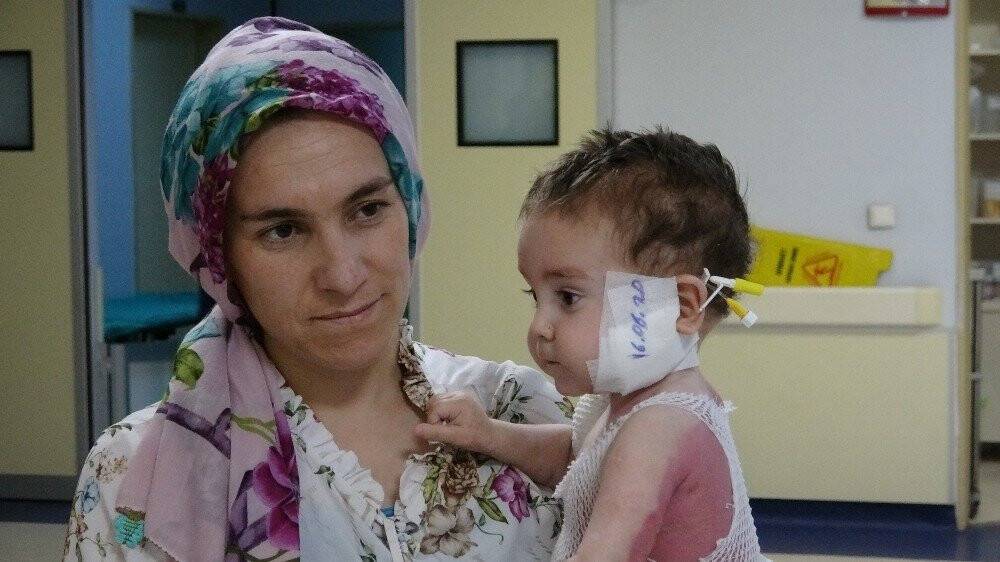 Kaynar Kazana düşen bebek hayata tutundu