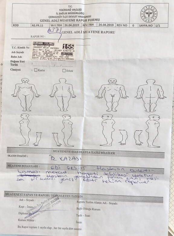 İşçinin yemeğinden, kopmuş parmak çıktı.