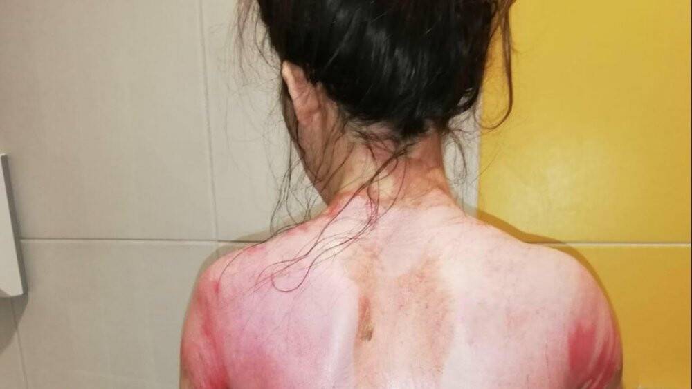 Eşinin kaynar suyla yaktığı Rukiye A: Ölmek istemiyorum