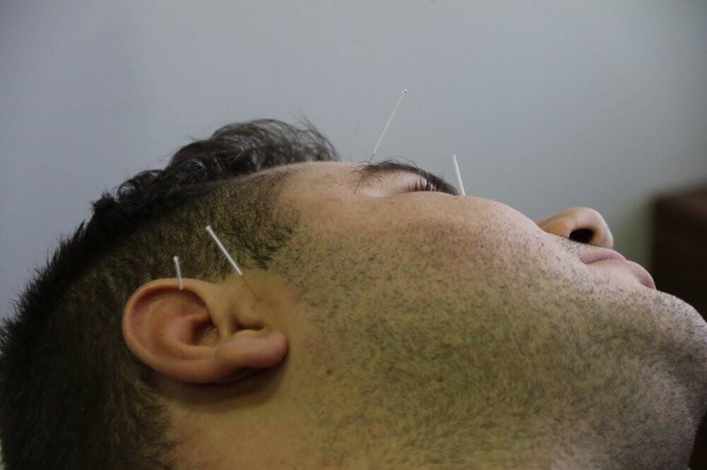Fazla kilolara karşı akupunktur