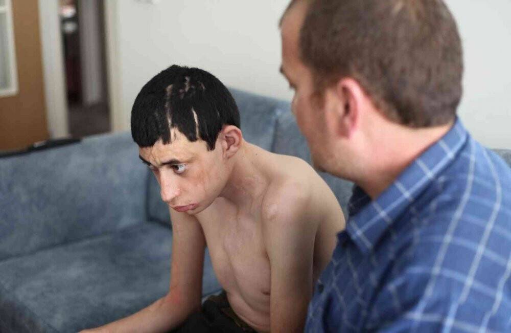 Kezzap atılan engelli çocuk ile ailesinin yaşam mücadelesi