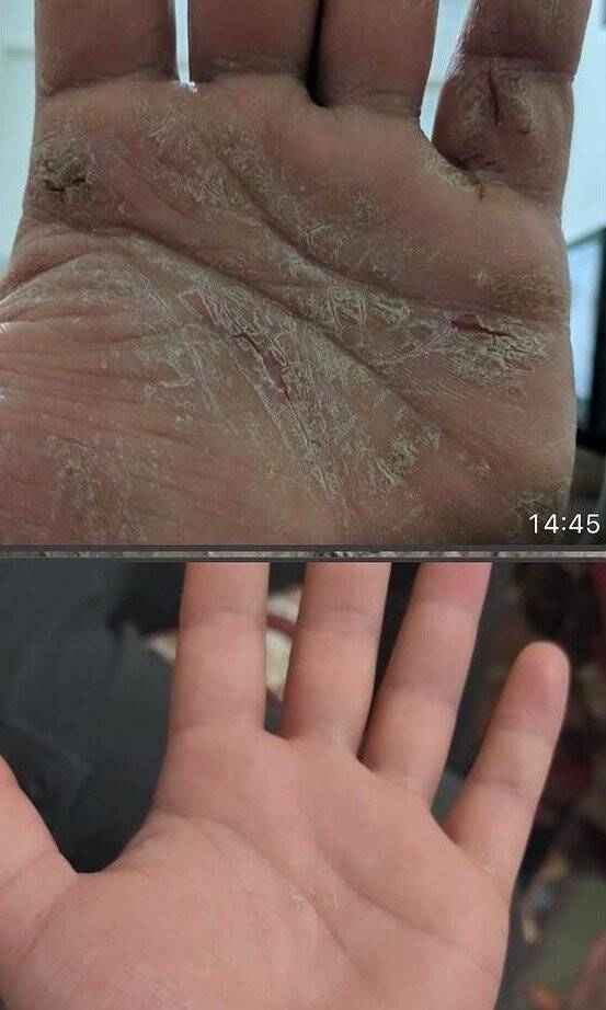 Yaptığı bitkisel karışımla sedef hastalığına çare buldu