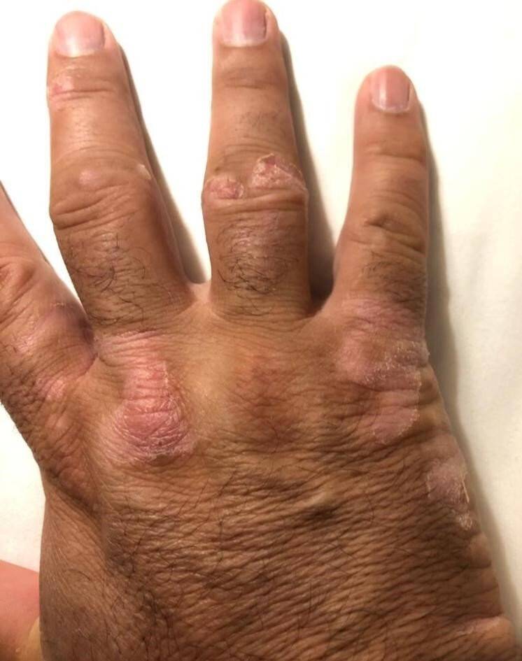 Yaptığı bitkisel karışımla sedef hastalığına çare buldu