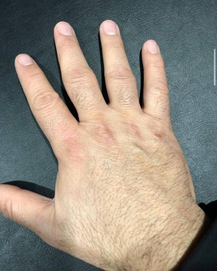 Yaptığı bitkisel karışımla sedef hastalığına çare buldu