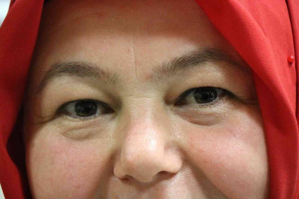 Akıllı mercek sayesinde yıllardır kullandığı gözlükten kurtuldu