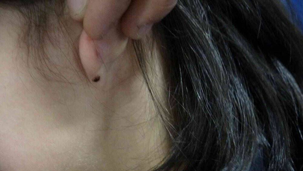 Kulağına kene yapışan küçük çocuk hastaneye kaldırıldı