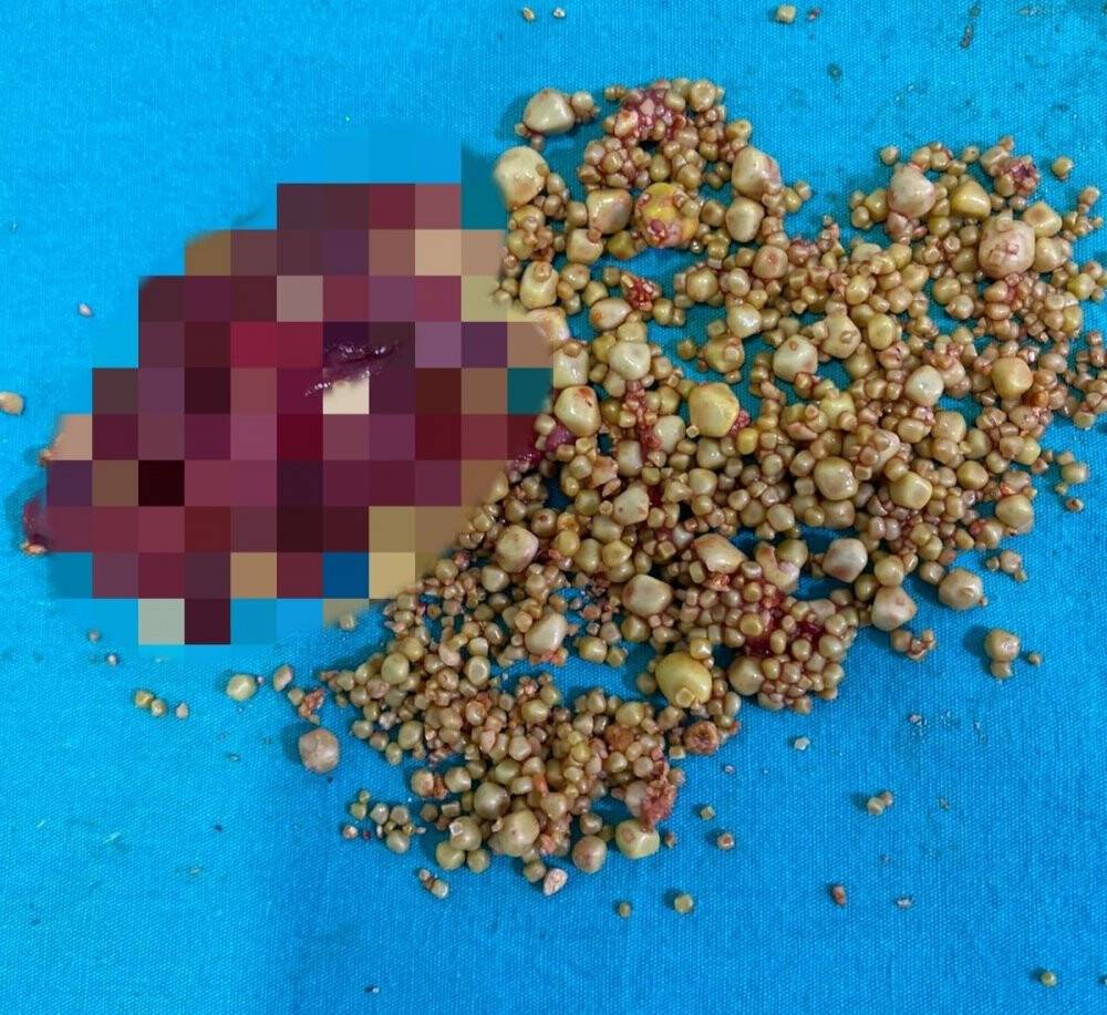 76 yaşındaki hastanın safra kesesinden bin 284 taş çıktı