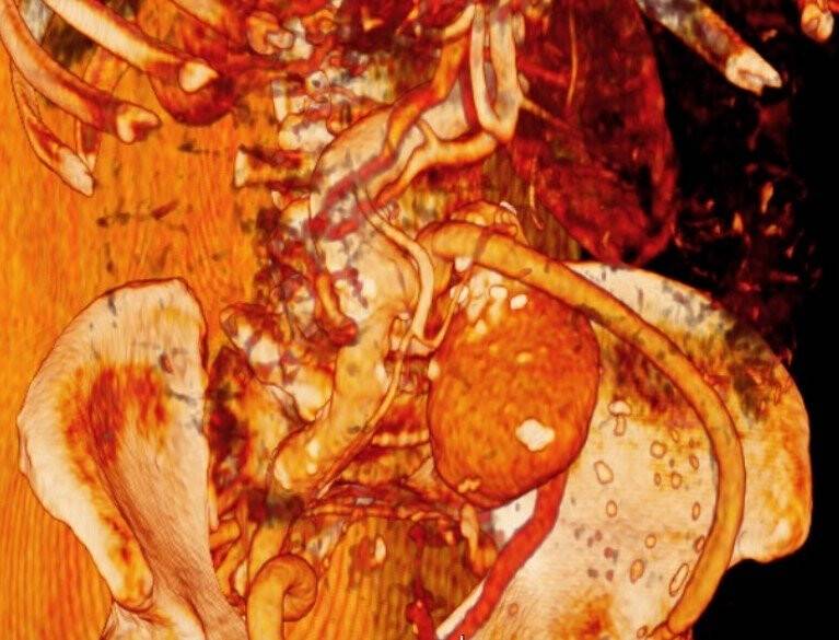 Yaşlı adamın aort damarı karpuz gibi büyüdü