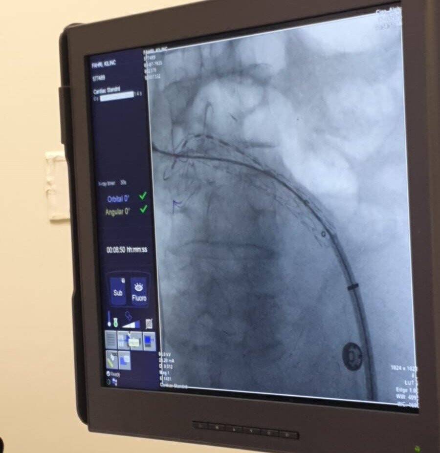 Yaşlı adamın aort damarı karpuz gibi büyüdü