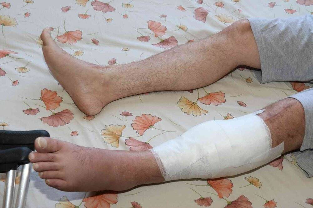 Bacağını kaybetme tehlikesi yaşarken adalet istiyor
