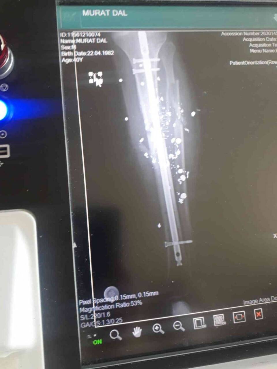 Bacağını kaybetme tehlikesi yaşarken adalet istiyor