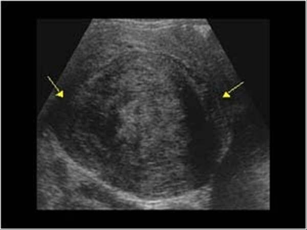 Karındaki şişlik kilo değil miyom olabilir