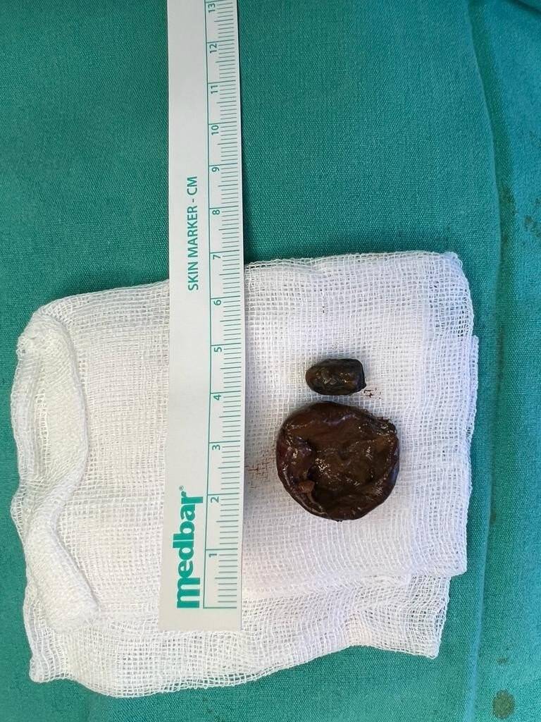 50 yıldır burnunda mermiyle yaşadı