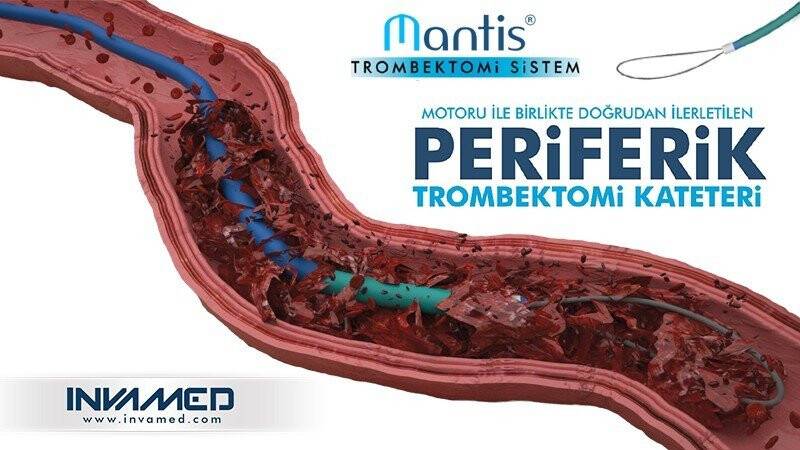 Tedavi edilmeyen her 3 akciğer embolisi vakasından biri ölümle sonuçlanıyor